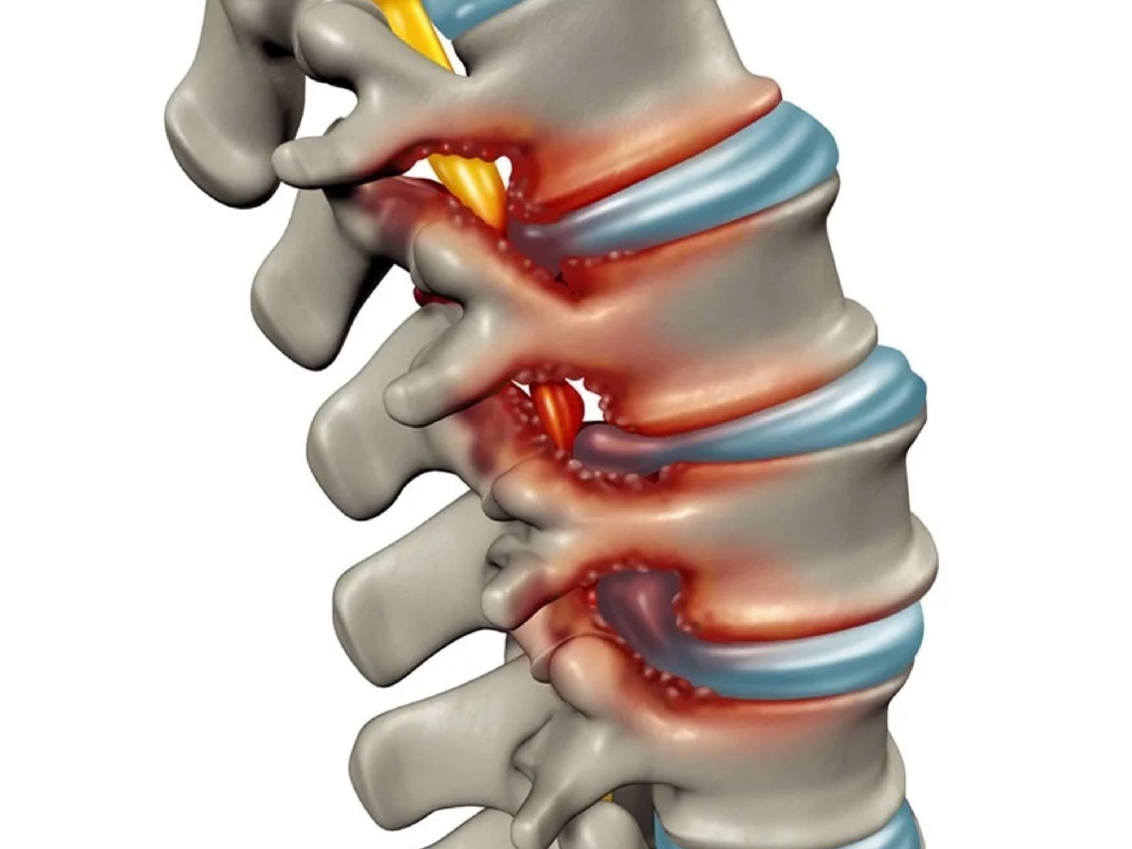 Spine Disease